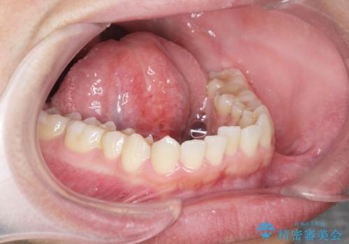 [滑舌を治したい] 舌の小帯の形成術の症例 治療後