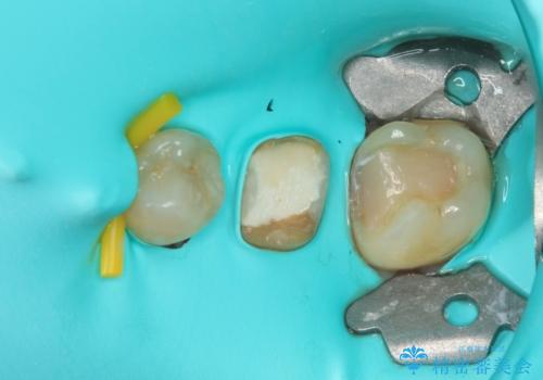 処置を先延ばしにしていたむし歯 奥歯のセラミック治療の治療中
