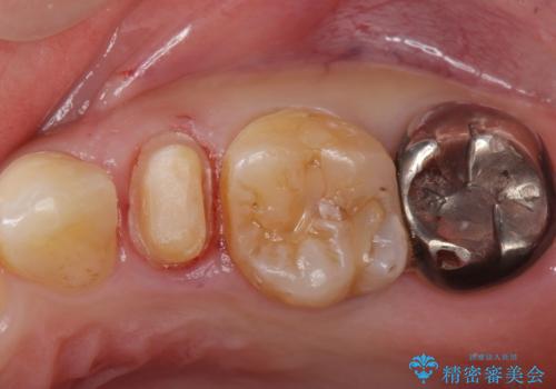 保険で被せた白い被せ物をやりかえたい。の治療中