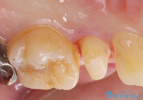 保険で被せた白い被せ物をやりかえたい。の治療中