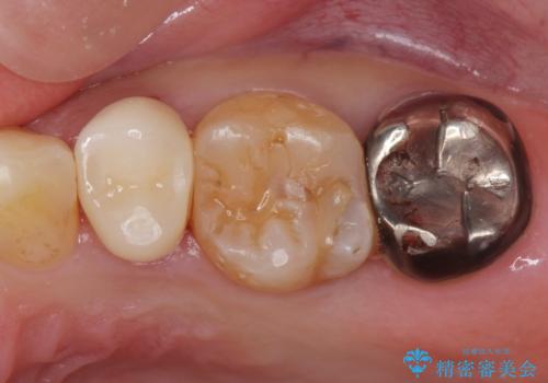 保険で被せた白い被せ物をやりかえたい。の治療後