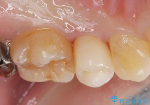 保険で被せた白い被せ物をやりかえたい。の治療後