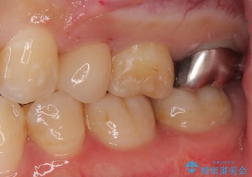 保険で被せた白い被せ物をやりかえたい。の治療後