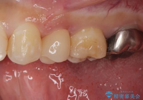 保険で被せた白い被せ物をやりかえたい。の治療後