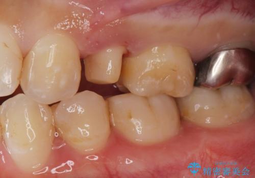 保険で被せた白い被せ物をやりかえたい。の治療中