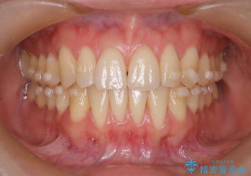 【インビザライン】反対咬合を治したいの治療中