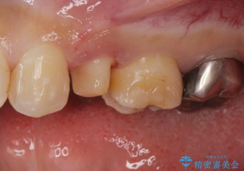 保険で被せた白い被せ物をやりかえたい。の治療中