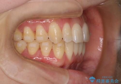 【インビザライン】反対咬合を治したいの治療中