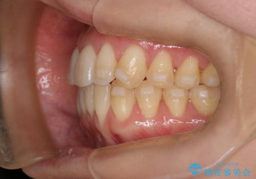 【インビザライン】反対咬合を治したいの治療中