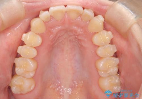 【インビザライン】反対咬合を治したいの治療中