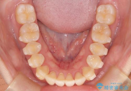 【インビザライン】反対咬合を治したいの治療中