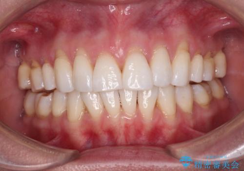 後戻りで突出した口元を引っ込めたい インビザライン矯正治療の治療中
