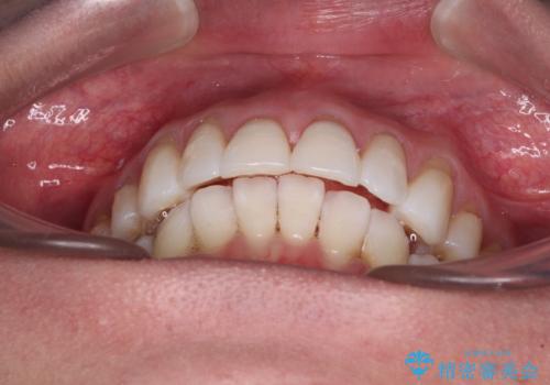 後戻りで突出した口元を引っ込めたい インビザライン矯正治療の治療中