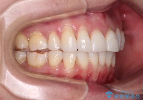 後戻りで突出した口元を引っ込めたい インビザライン矯正治療の治療中