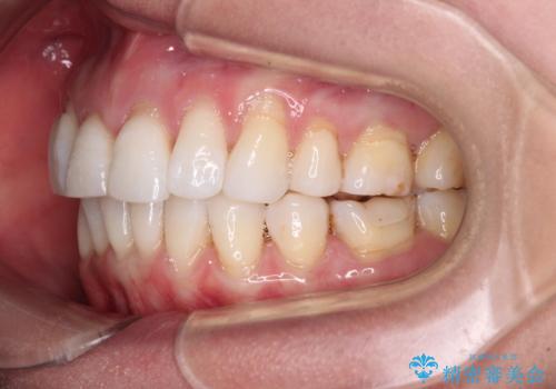 後戻りで突出した口元を引っ込めたい インビザライン矯正治療の治療中