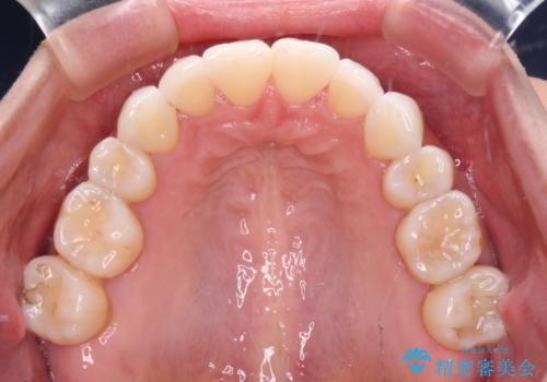 後戻りで突出した口元を引っ込めたい インビザライン矯正治療の治療中