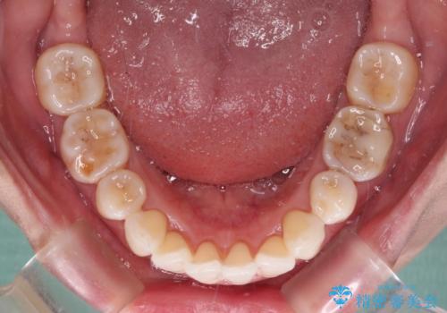 後戻りで突出した口元を引っ込めたい インビザライン矯正治療の治療中