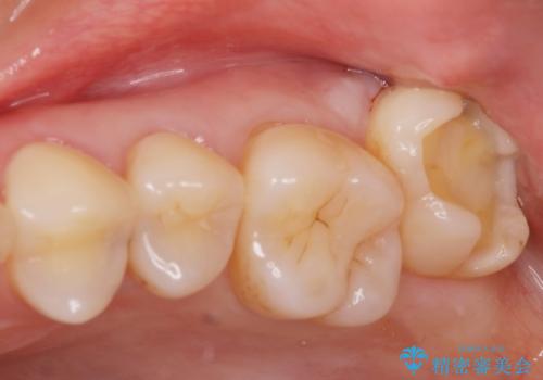 奥歯の黒いのが気になる。の治療中