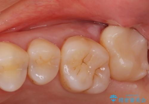 奥歯の黒いのが気になる。の症例 治療後