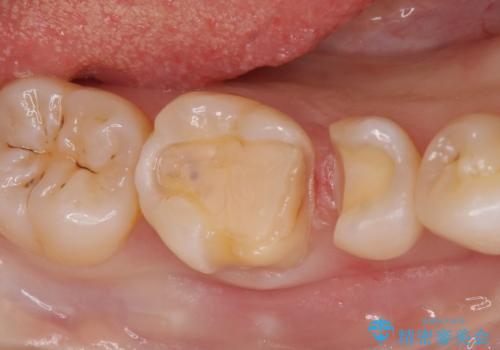 劣化した保険の詰め物部分の治療をしたい。の治療中
