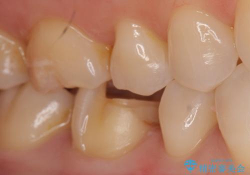 劣化した保険の詰め物部分の治療をしたい。の治療中