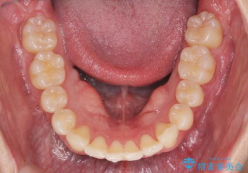 ワイヤー矯正がしたいの治療後