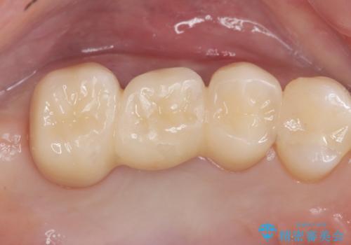 銀の詰め物を白くしたい。の症例 治療後