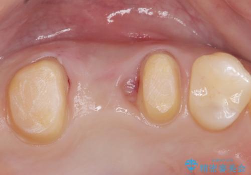 銀の詰め物を白くしたい。の治療中