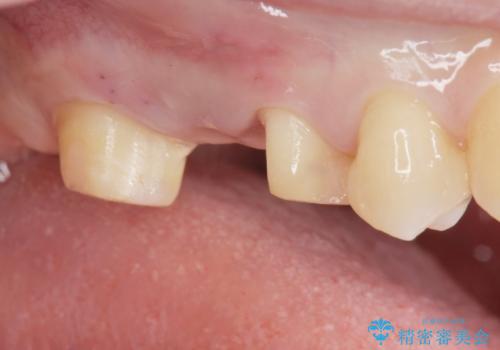 銀の詰め物を白くしたい。の治療中