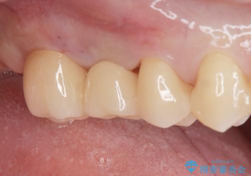 銀の詰め物を白くしたい。の治療後