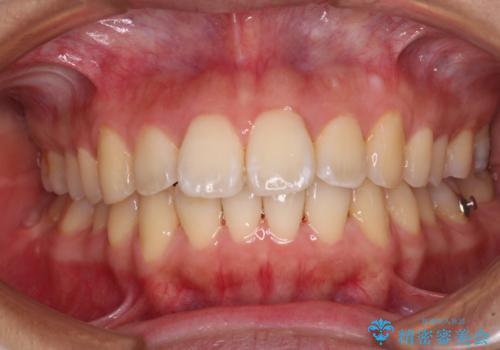 前に出ている前歯を引っ込めたい インビザライン矯正の治療中