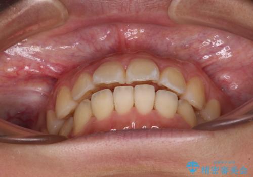 前に出ている前歯を引っ込めたい インビザライン矯正の治療中