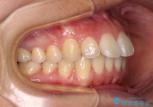 前に出ている前歯を引っ込めたい インビザライン矯正の治療中