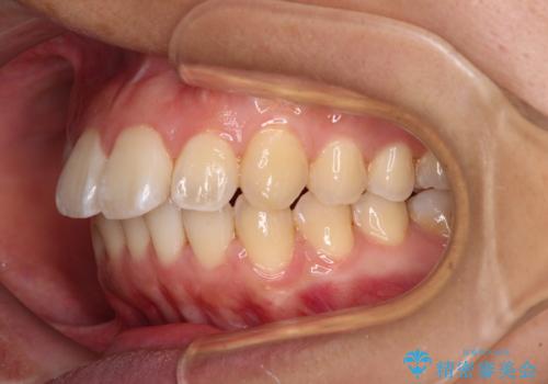 前に出ている前歯を引っ込めたい インビザライン矯正の治療中