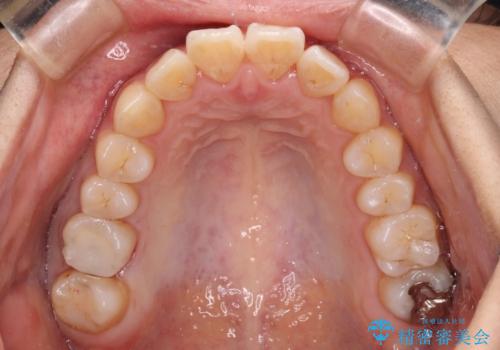 前に出ている前歯を引っ込めたい インビザライン矯正の治療中