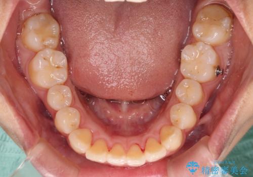 前に出ている前歯を引っ込めたい インビザライン矯正の治療中