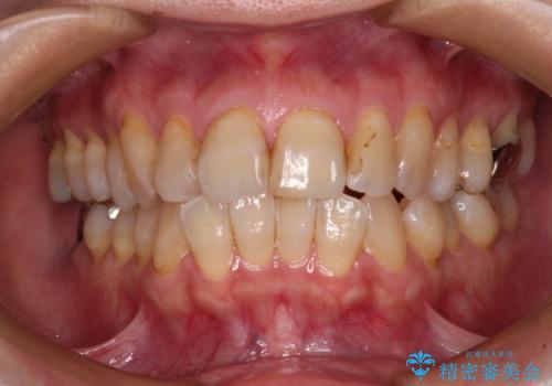 【モニター】前歯の突出感を抜歯矯正で改善の症例 治療前