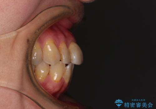 【モニター】前歯の突出感を抜歯矯正で改善の治療前