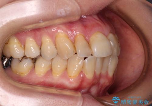 【モニター】前歯の突出感を抜歯矯正で改善の治療前