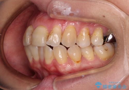 【モニター】前歯の突出感を抜歯矯正で改善の治療前
