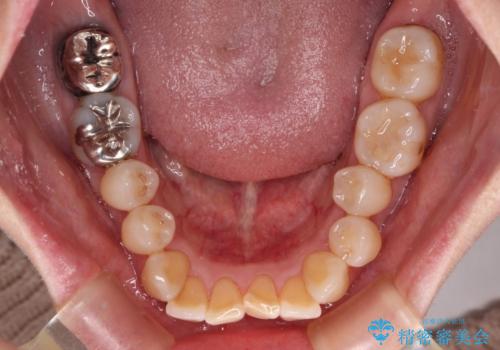 【モニター】前歯の突出感を抜歯矯正で改善の治療前