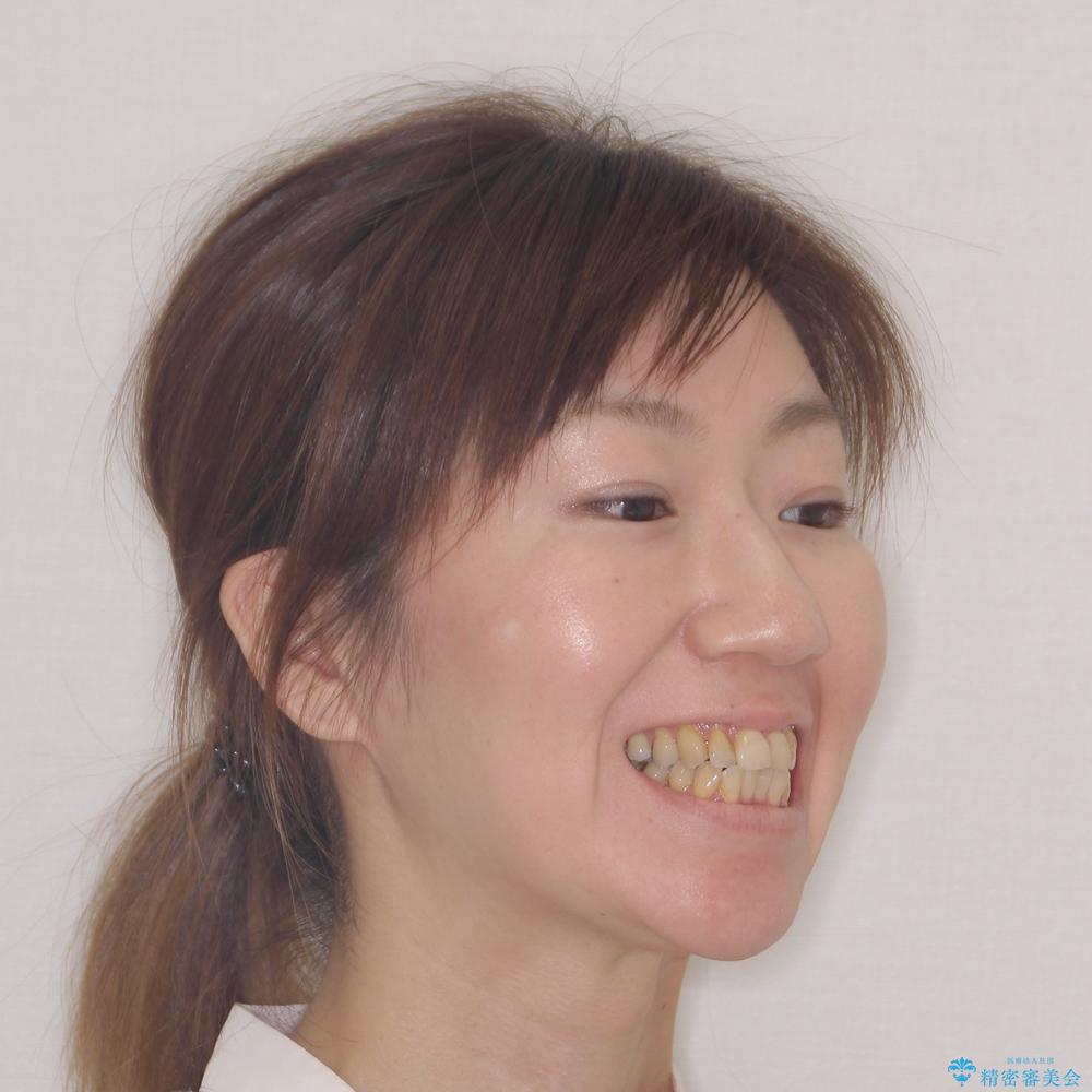 【モニター】前歯の突出感を抜歯矯正で改善の治療前（顔貌）