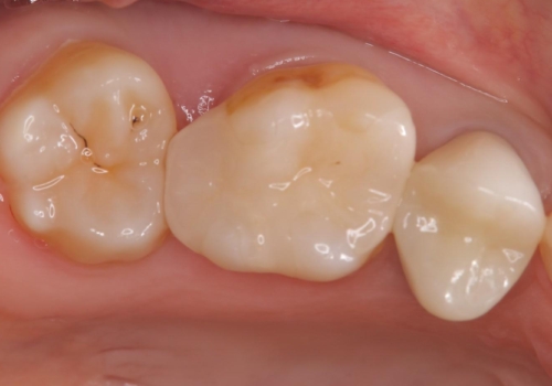 物が詰まりやすく歯茎が腫れるの治療前