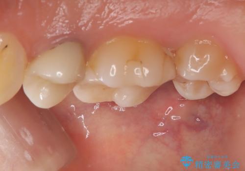 物が詰まりやすく歯茎が腫れるの治療前