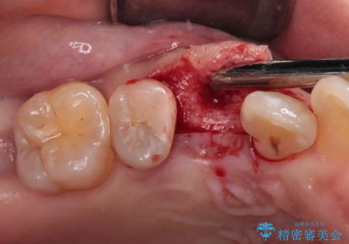 虫歯で失われた前歯　インプラントによる補綴治療の治療中