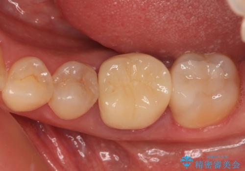 処置を先延ばしにしていたむし歯 奥歯のセラミック治療の症例 治療後