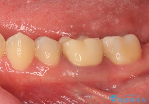 処置を先延ばしにしていたむし歯 奥歯のセラミック治療の治療後