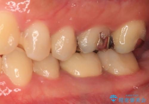 処置を先延ばしにしていたむし歯 奥歯のセラミック治療の治療後