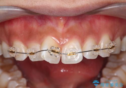 ワイヤーの小矯正を行い、治療期間を短縮するマウスピース治療の治療前