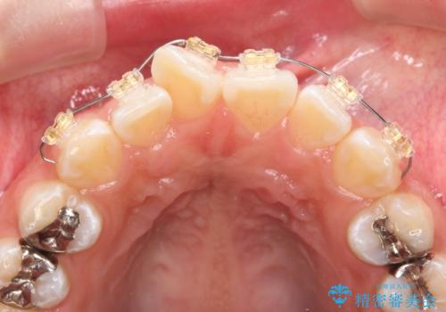 ワイヤーの小矯正を行い、治療期間を短縮するマウスピース治療の治療前